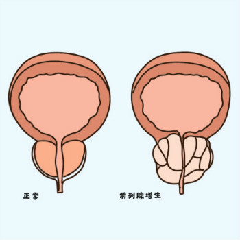 前列腺增生有哪些症状?前列腺增生如何治疗? 前列腺增生有哪些症状?前列腺增生如何治疗?